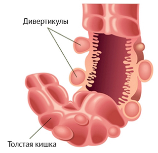 Дивертикулез кишечника